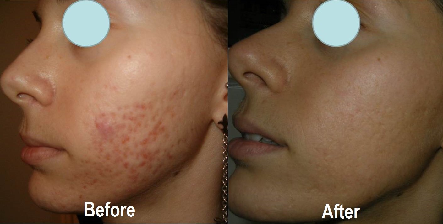 KCC patient before and after a course of medical salicylic-acid peels for active acne and post-inflammatory marks