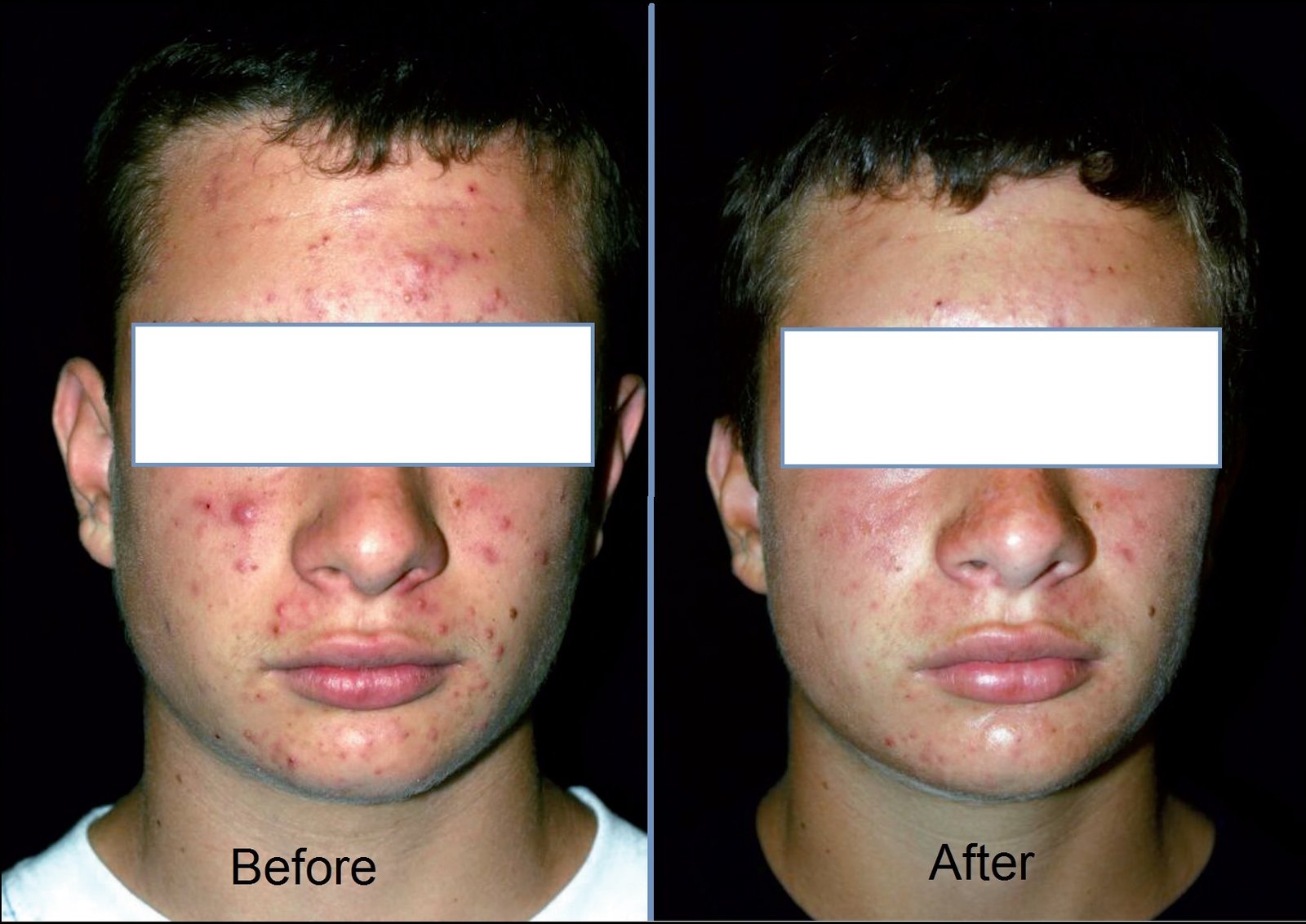 KCC patient before and after a twelve-week course of pharmaceutical-grade peels for inflammatory acne