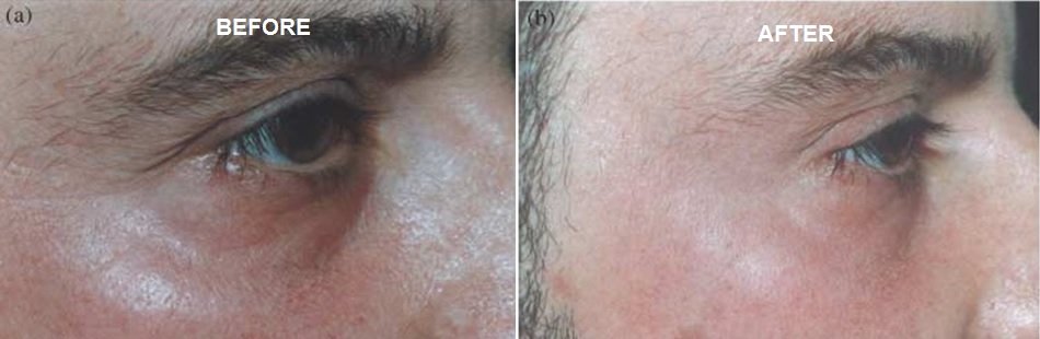 KCC patient before and after Enerpeel EL eye-area peel series, improvement in tone and texture