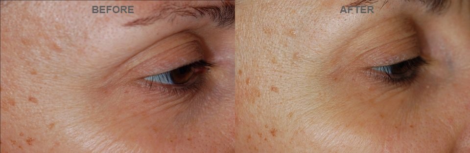 KCC patient before and after a course of light eye-area peels, softening of fine lines