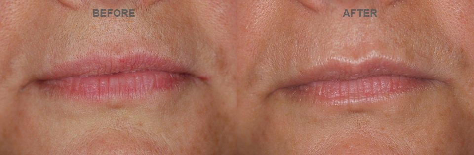 KCC patient before and after a targeted perioral peel programme for vertical lip lines