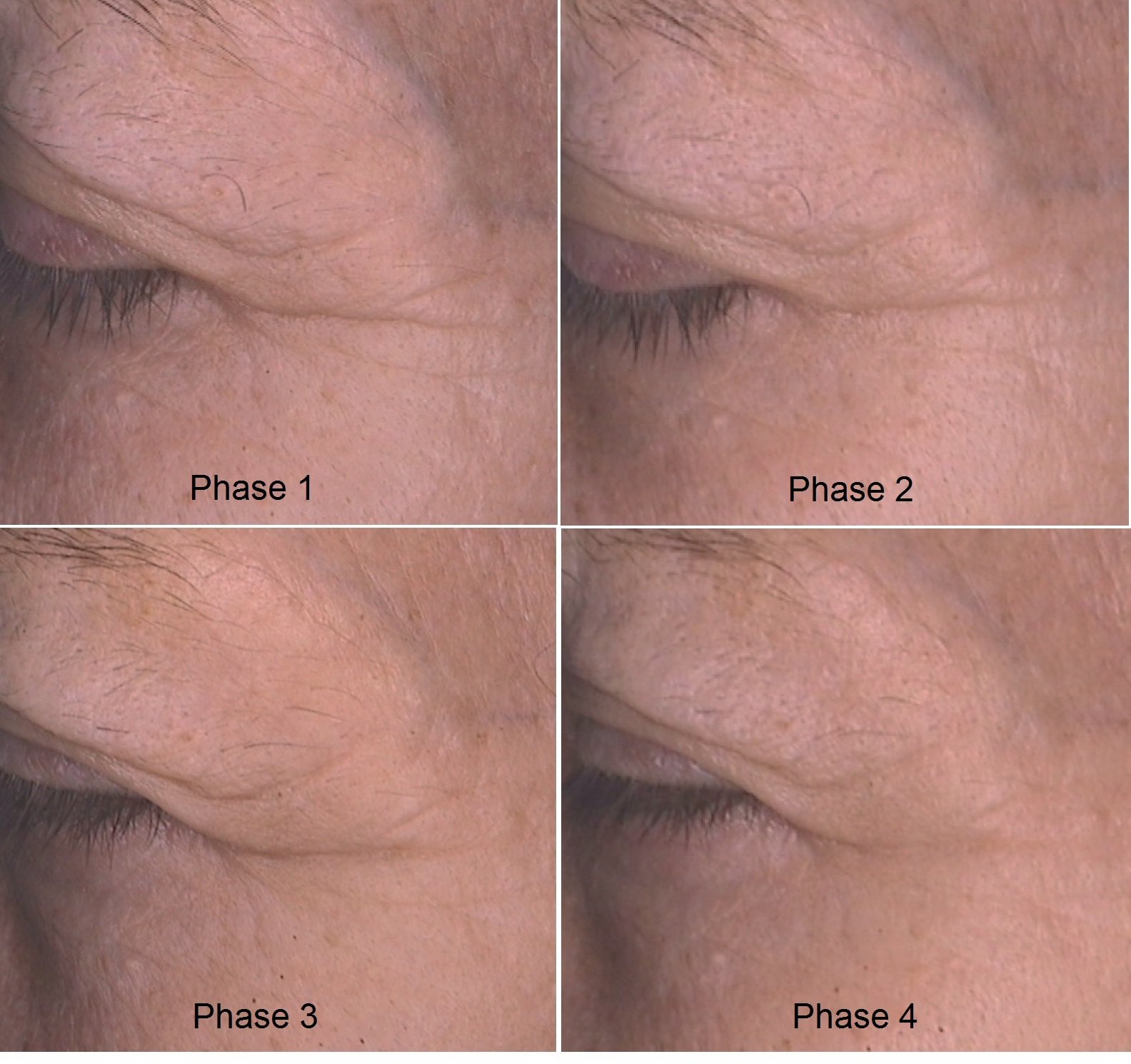 KCC patient periorbital wrinkle progression across four phases of a glycolic-acid peel programme