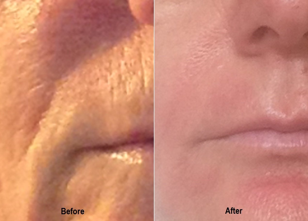 KCC patient before and after a series of medical microneedling sessions targeting perioral texture and fine lines
