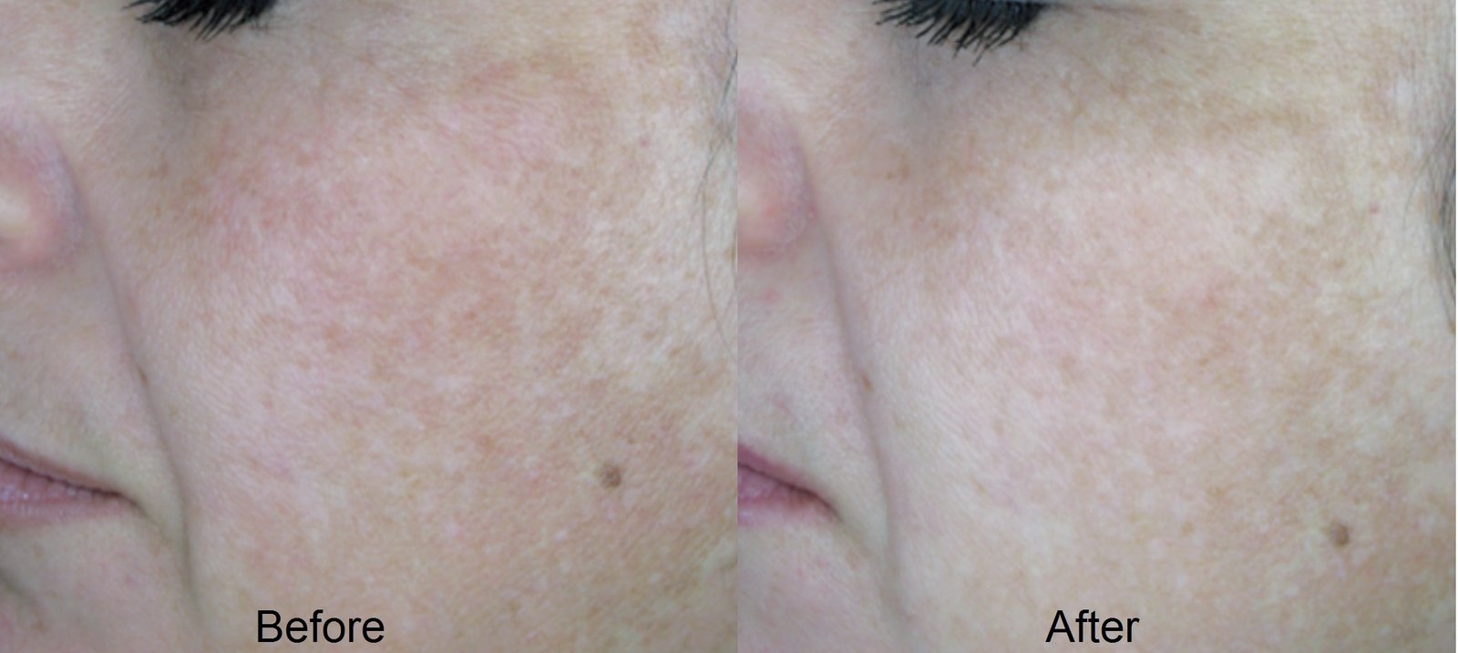 KCC patient before and after a sixty-day medical lightening protocol for cheek melasma