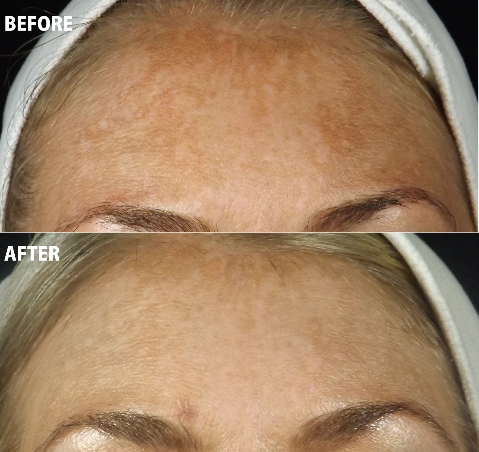 KCC patient before and after a targeted Enerpeel JR peel series for forehead pigmentation