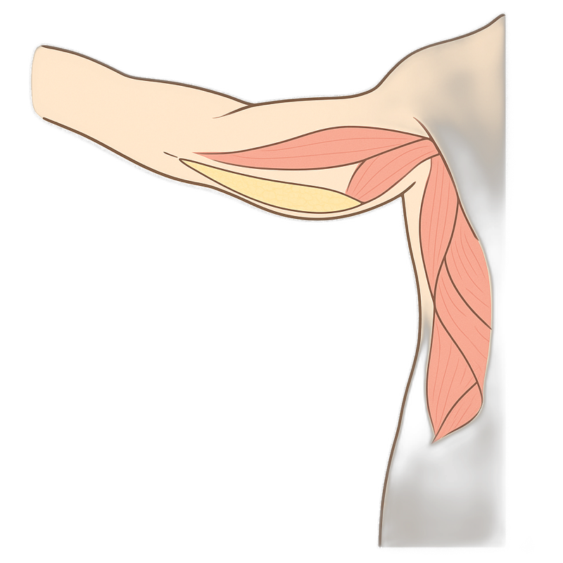 Inside a brachioplasty (arm lift), anatomical illustration